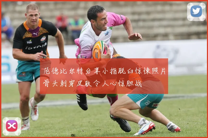 范德比尔特分享小指脱臼惊悚照片骨头刺穿皮肤令人心惊胆战